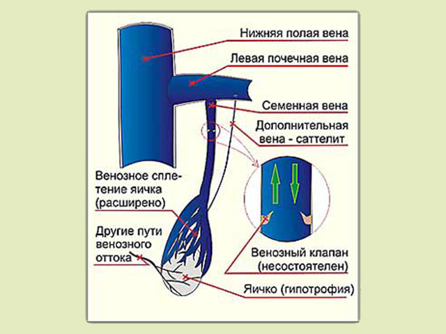 Варикоцеле у подростков: основные причины