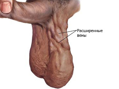 Варикоцеле и фото болезни