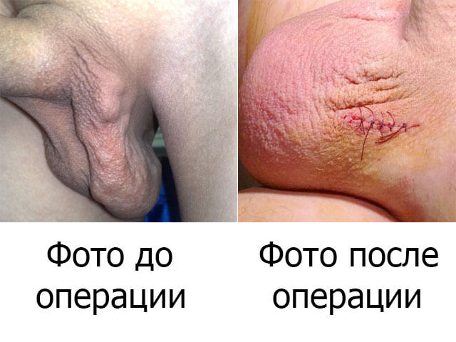 Варикоцеле, как выглядит на фото до и после операции