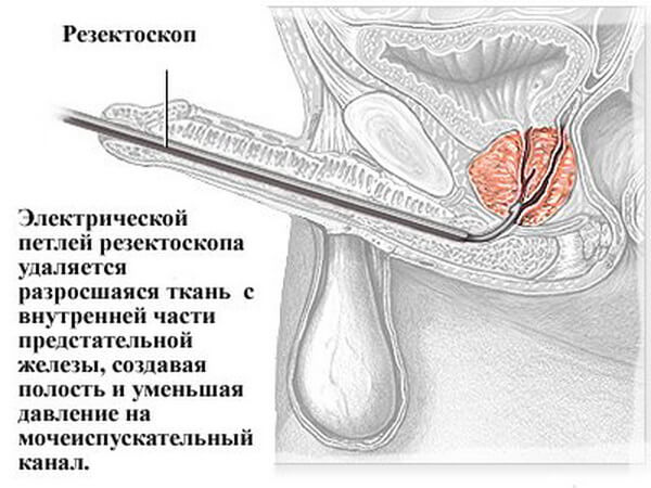 Операция ТУР высокоэффективна и малотравматична