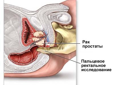 Стадии рака простаты диагностика