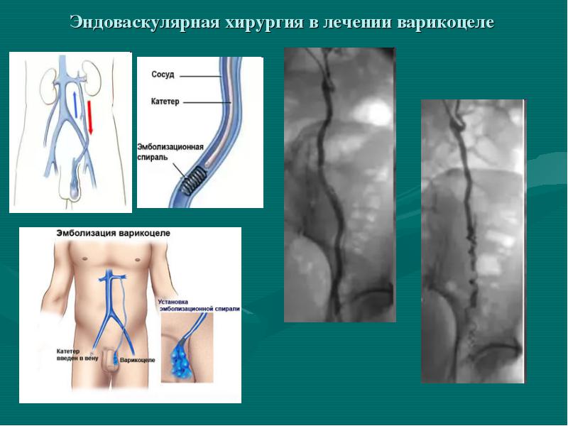 Лечение варикоцеле яичка