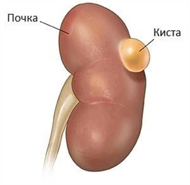 Солитарная киста почки: полное руководство по диагностике и управлению