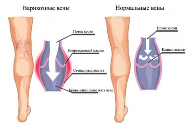 Варикозное расширение вен