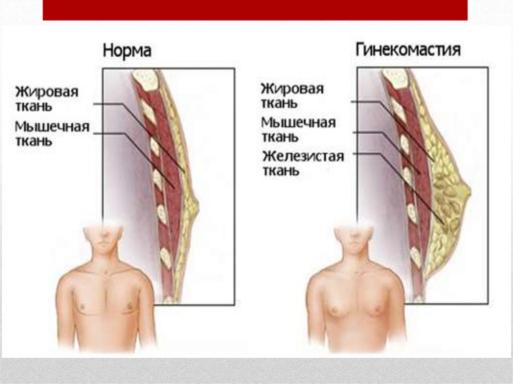 Гинекомастия