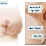 Цистоскопия