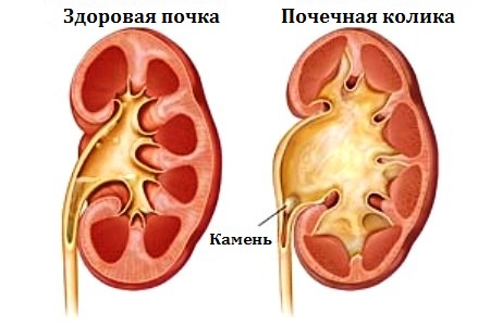 Сравнение здоровой и больной почек