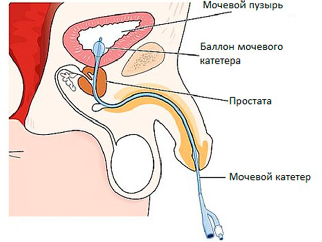 Катетер в мочевыводящем канале мужчины