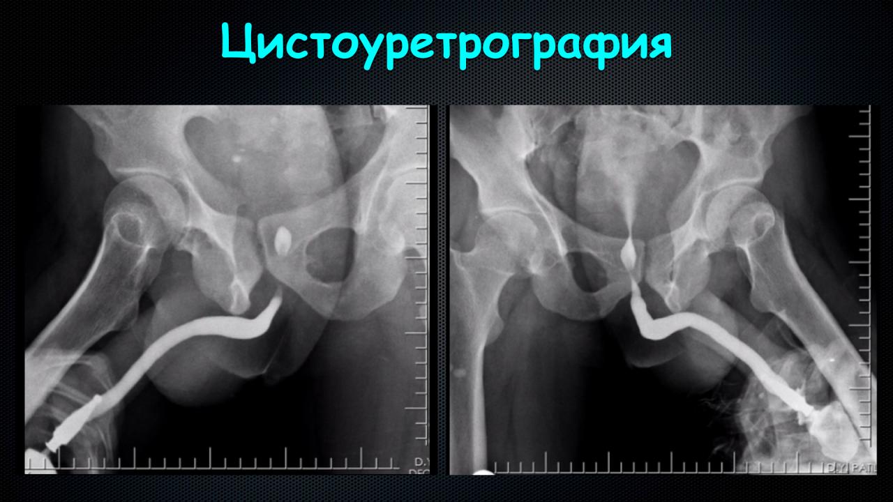 Снимок при цистоуретрографии