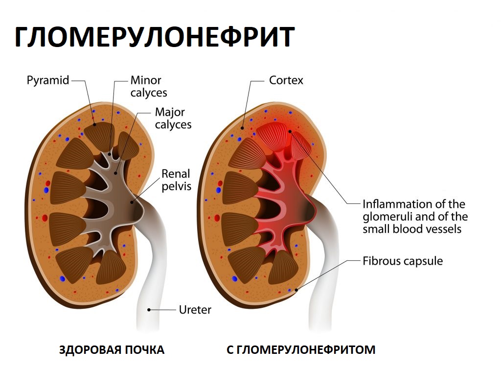 Гломерулонефрит