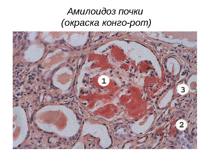 Амилоидоз почки под микроскопом