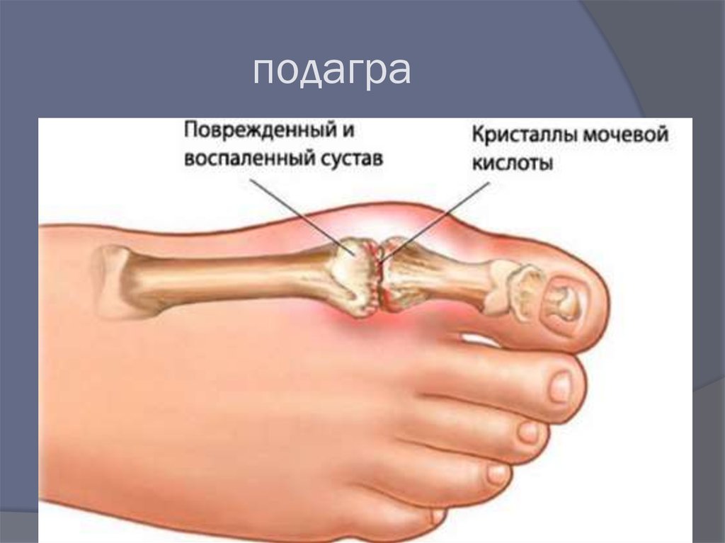 Подагрические узлы