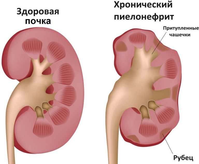 Здоровая почка и орган при хроническом пиелонефрите