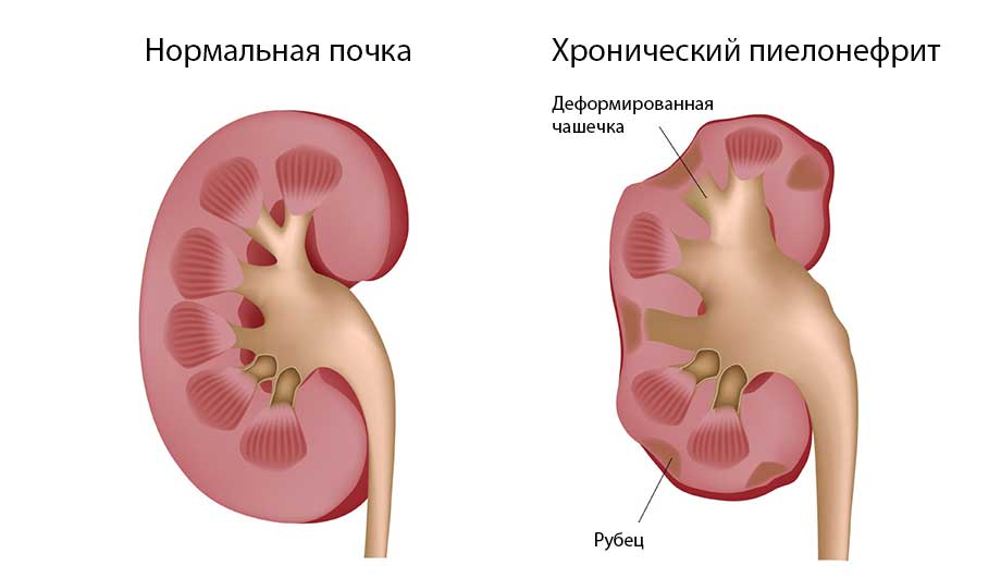 Почка при пиелонефрите