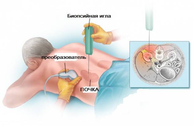 Пункционная биопсия почки