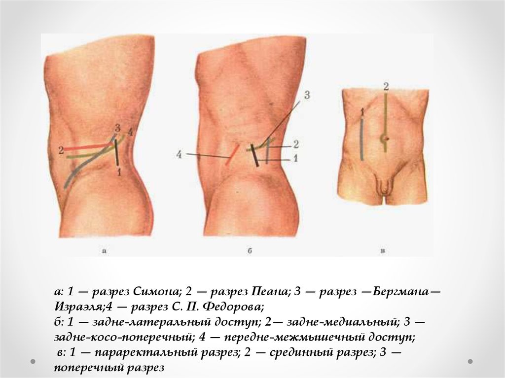 Варианты проведения люмботомии