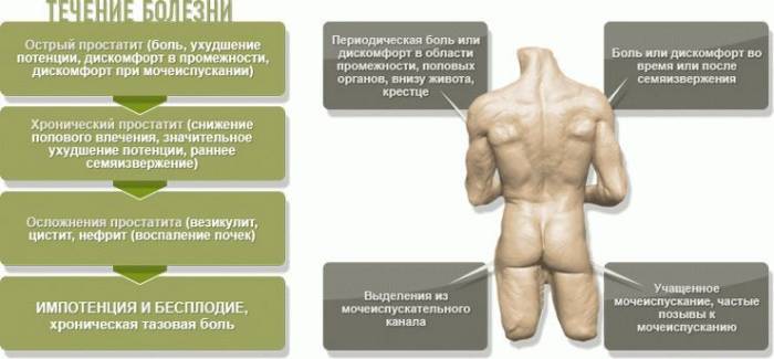 Варианты простатита и их симптоматика