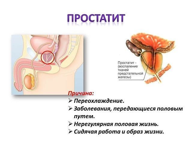 Схема причин простатита