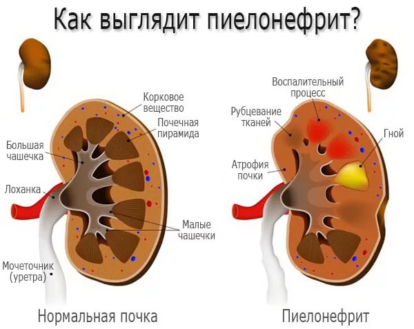 Здоровая почка и орган, поражённый пиелонефритом