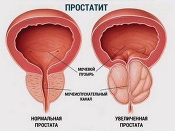 Разница между здоровой и воспалённой предстательной железой