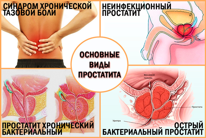 Основные виды простатита