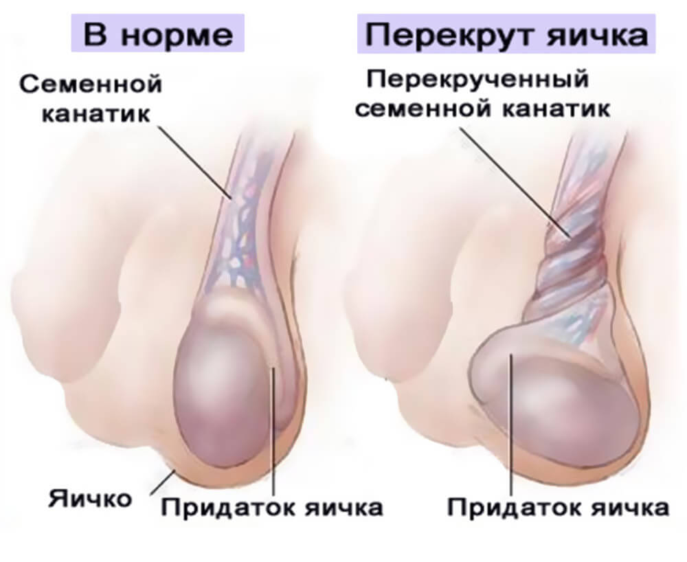 Нормальное положение яичка и перекрут