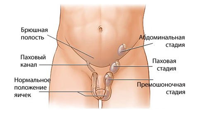 Крипторхизм