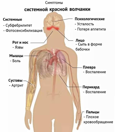Симптомы системной красной волчанки