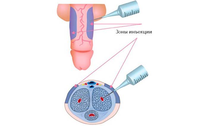 инъекця в зону пещеристых тел пениса