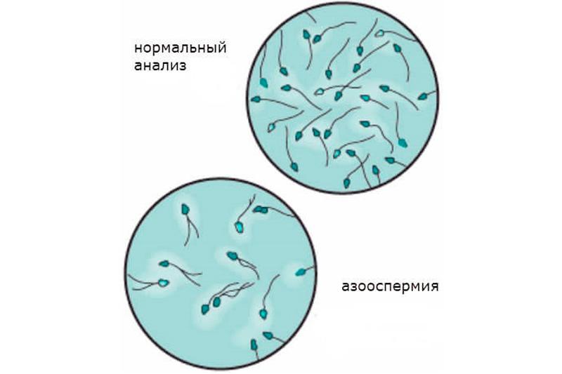 азоспермия