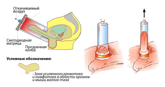 Терапия локальным отрицательным давлением (ЛОД)