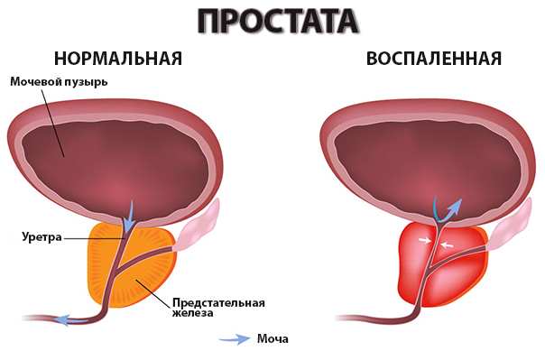 Нормальная и воспалённая простата