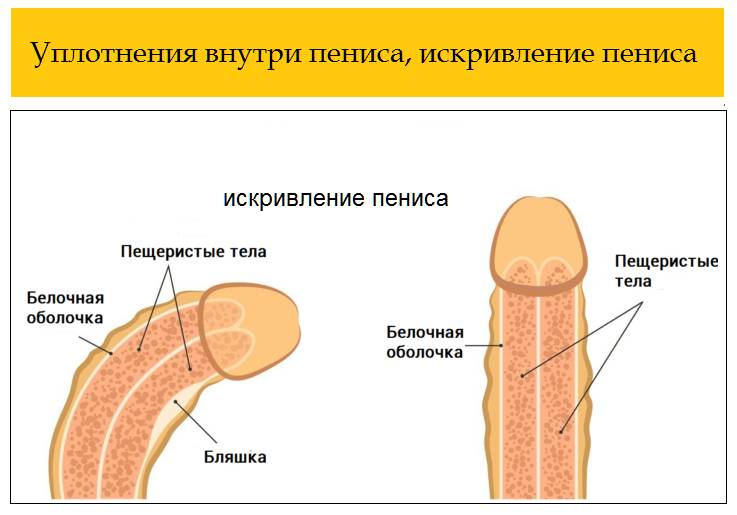 Искривление полового члена при болезни Пейрони