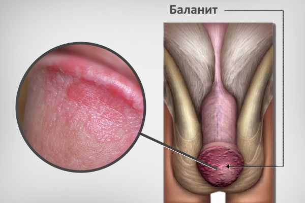 Баланит