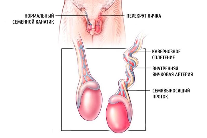 Перекрут мужского яичка