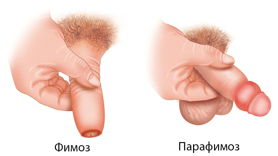 Фимоз и парафимоз полового члена