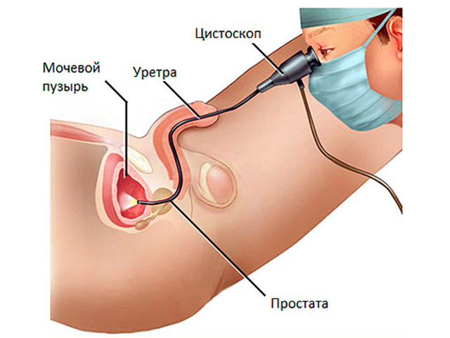 Уретрография у мужчин, схема