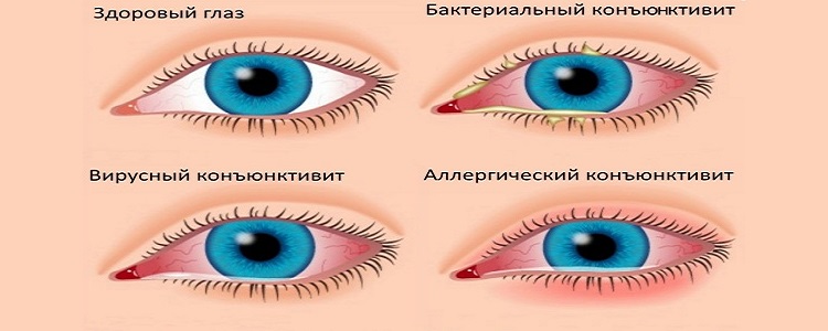 Герпетический конъюнктивит