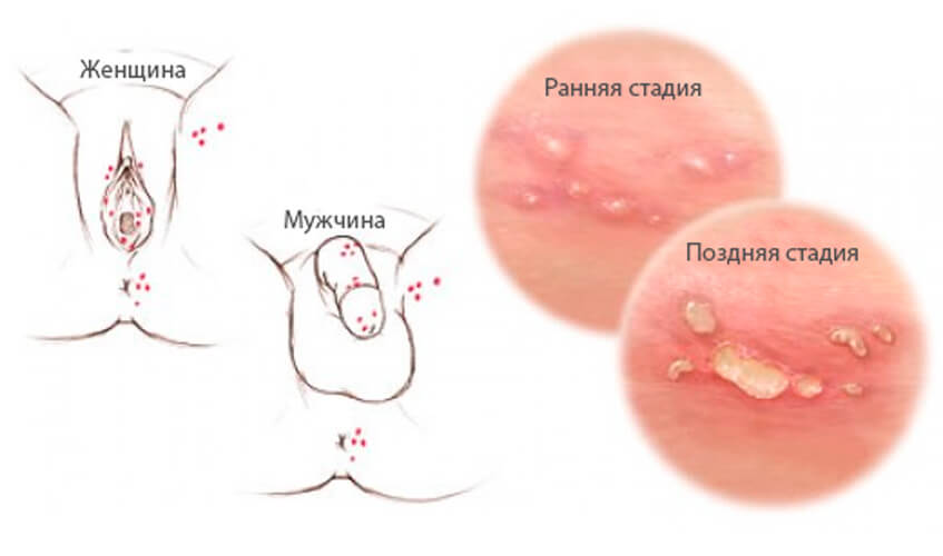 Симптомы генитального герпеса