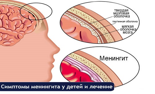 Инфекционный менингит