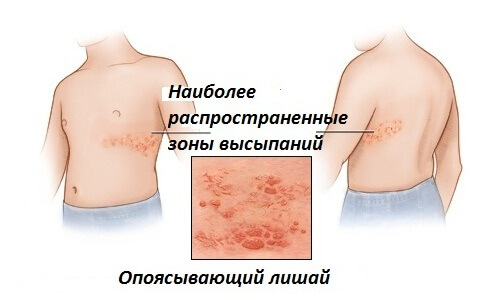 Опоясывающий лишай