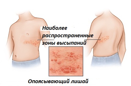 Опоясывающий лишай