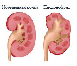 Осложнение на почки после ангины