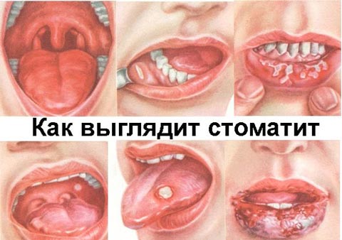 Стоматит