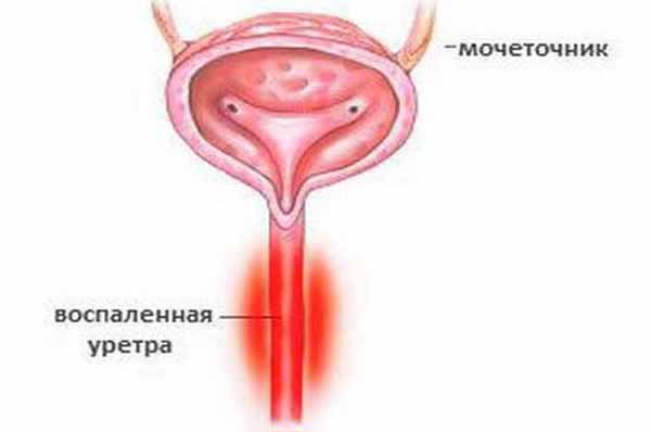 Уретропростатит