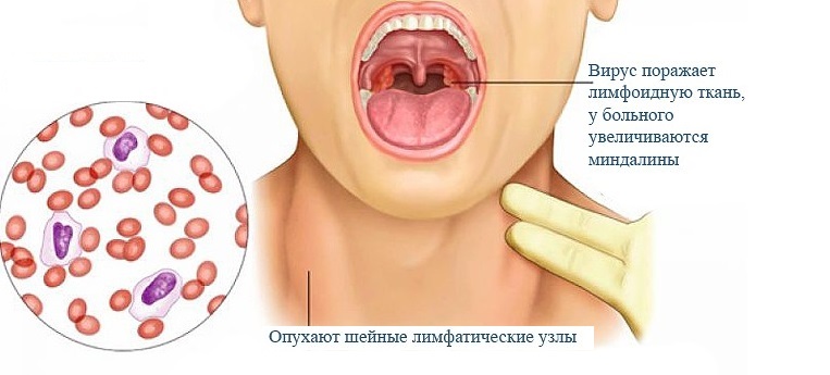 Вирус Эпштейна Барр