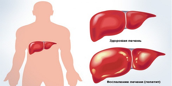Воспаление печени